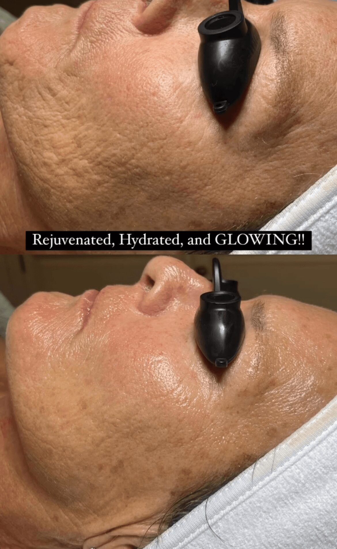 Before and after facial treatment showing skin improvement, with a black device on the cheek, caption about skin rejuvenation.