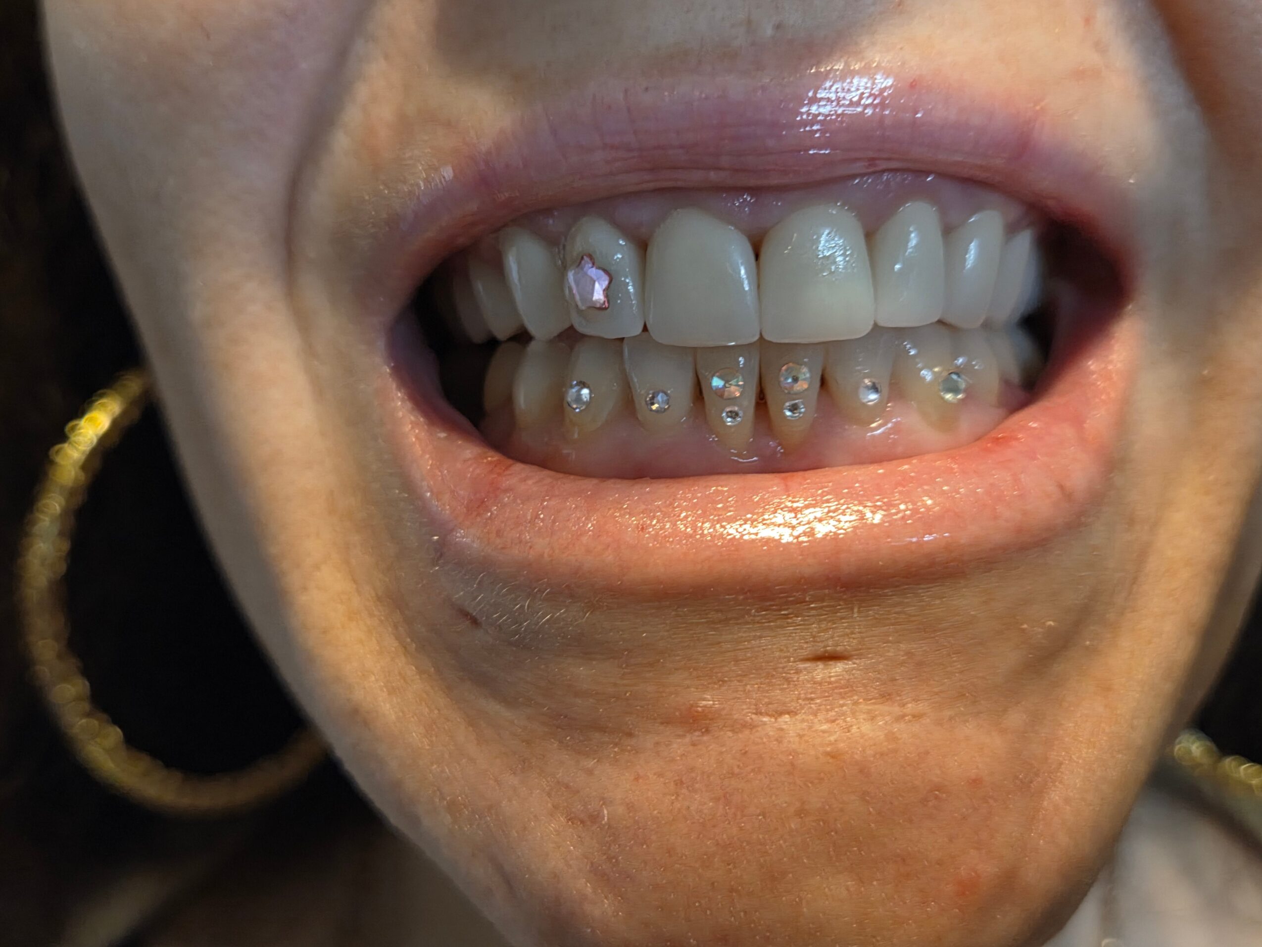 Close-up of a person's open mouth showing teeth and gums, with some missing and dental issues present.