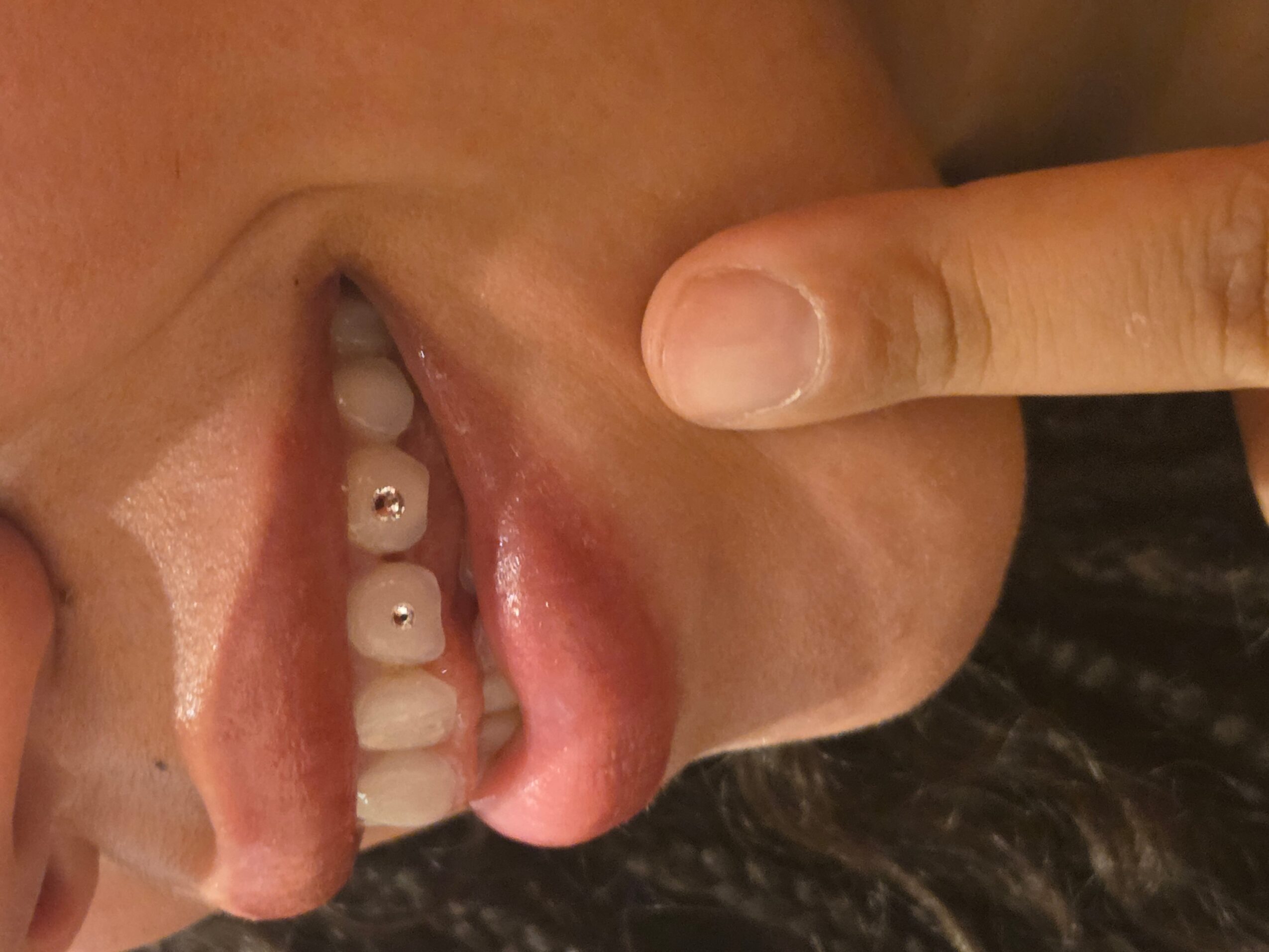 Close-up of a person's open mouth with visible teeth and tongue, finger pointing at the cheek, background dark.