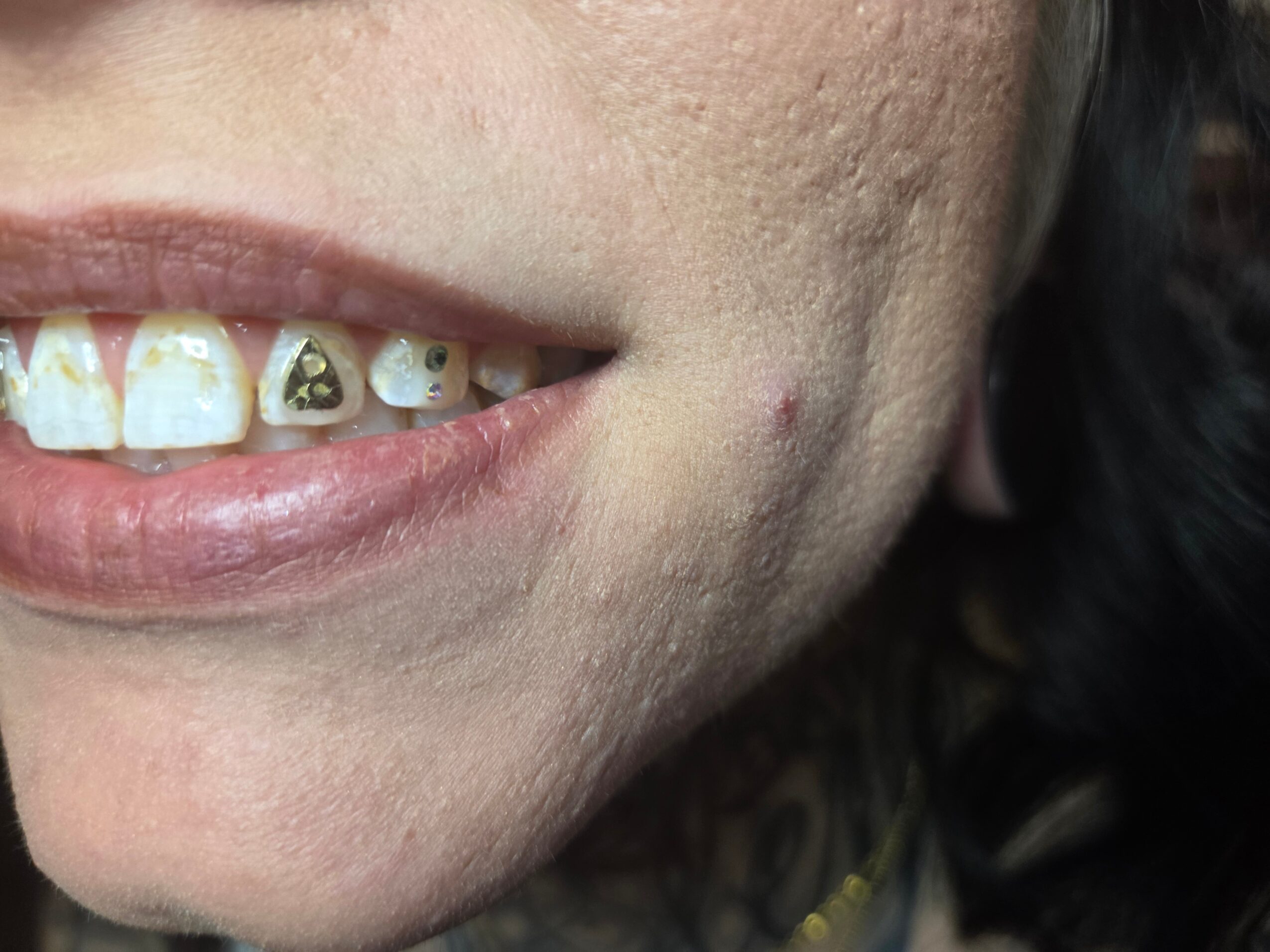 Close-up of a person's mouth showing teeth with dental issues and a small pimple on the cheek.