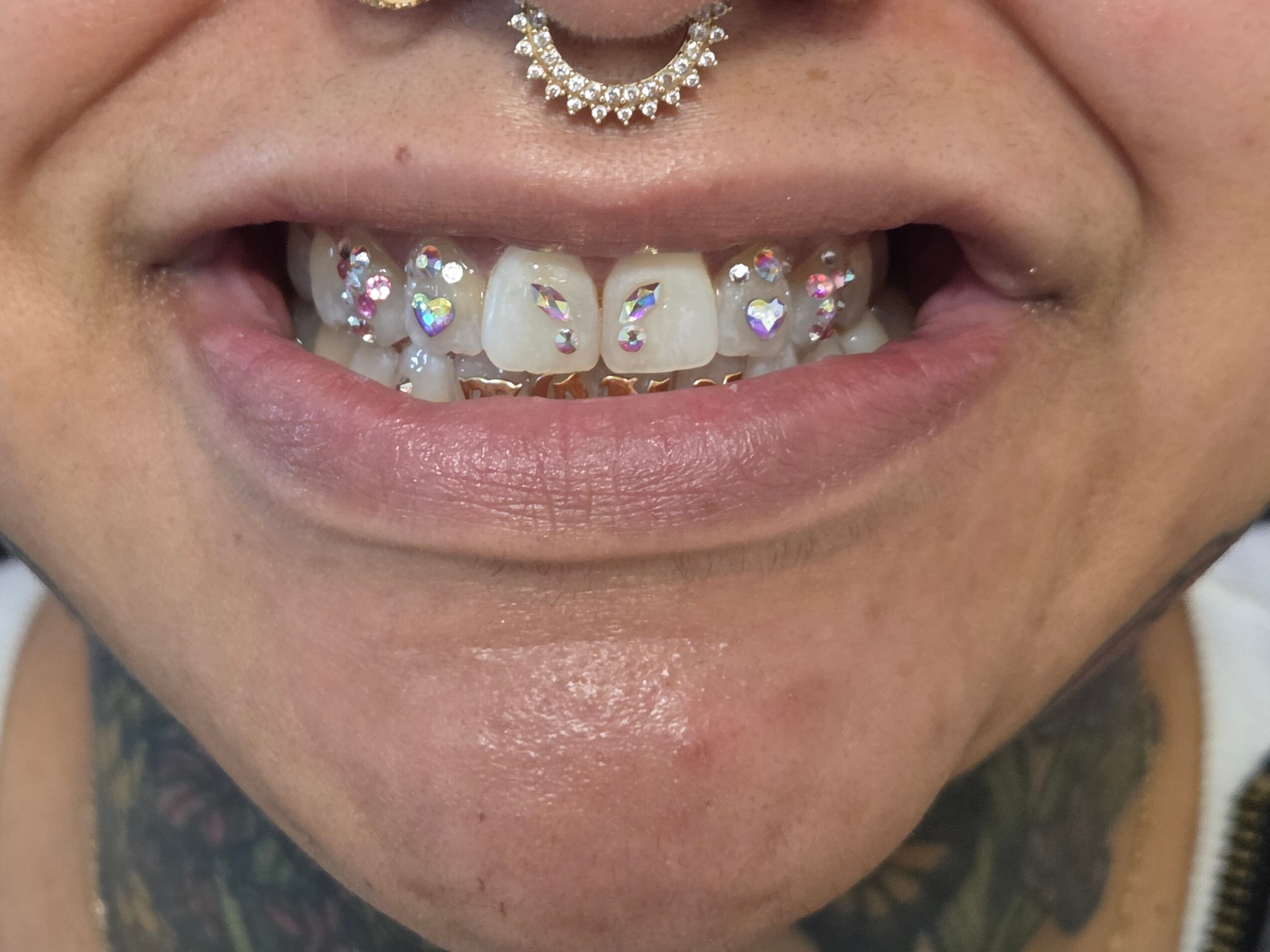 Close-up of a person's mouth showing teeth with braces and decorative jewelry, smiling slightly.