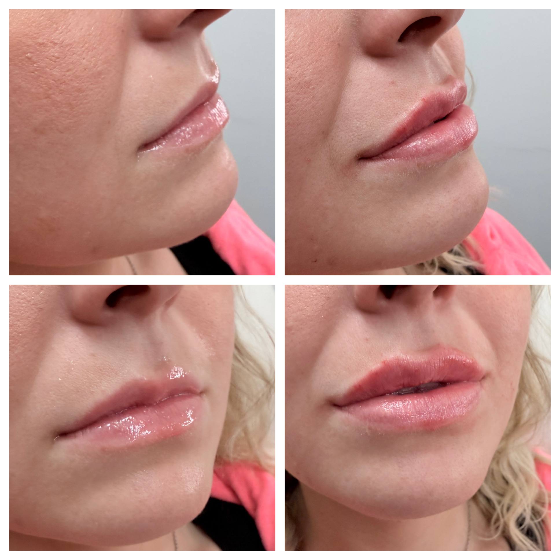 Close-up of lips before and after cosmetic enhancement, showing fuller lips with gloss, in four images.