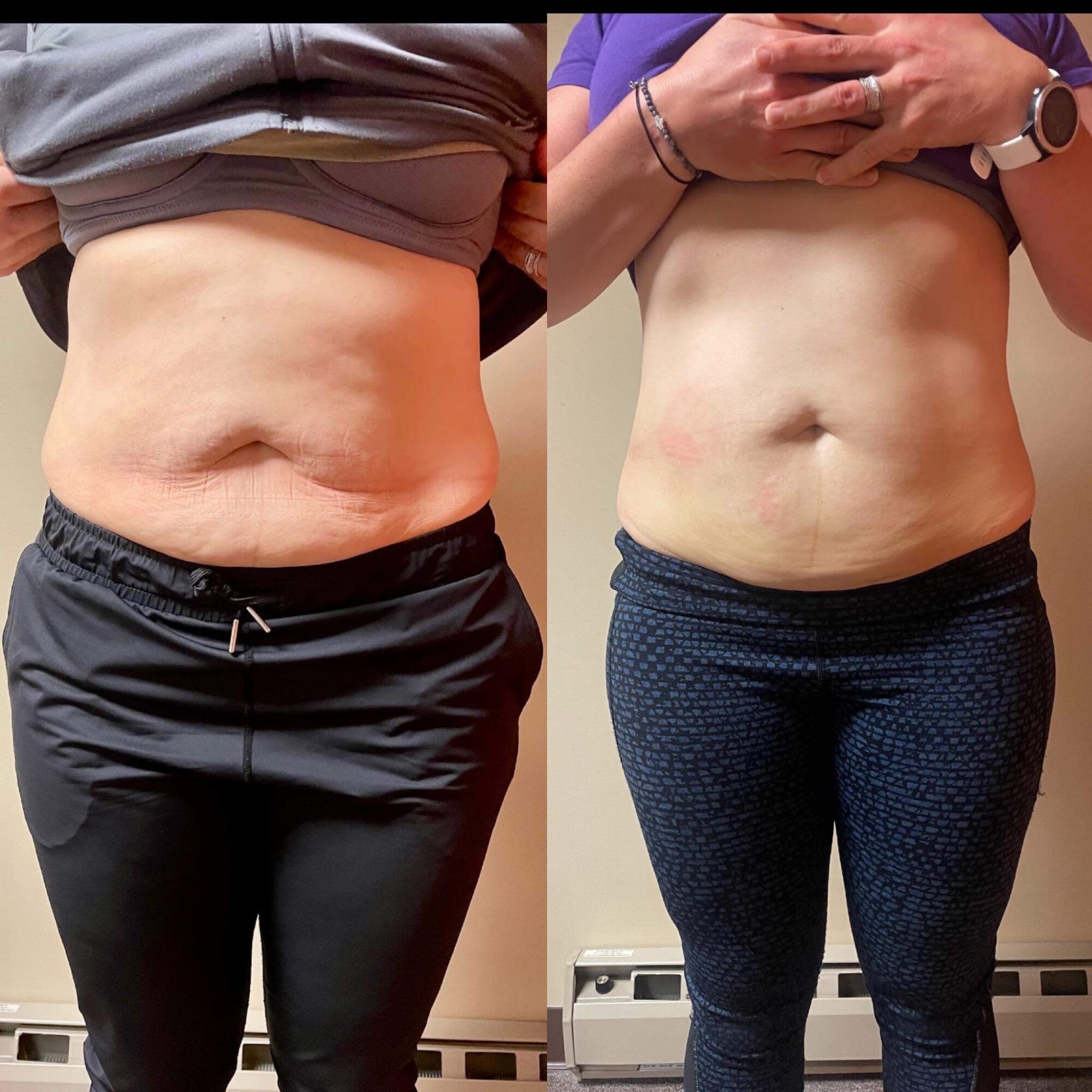Before and after images of a person's abdomen showing skin tightening and improved appearance.