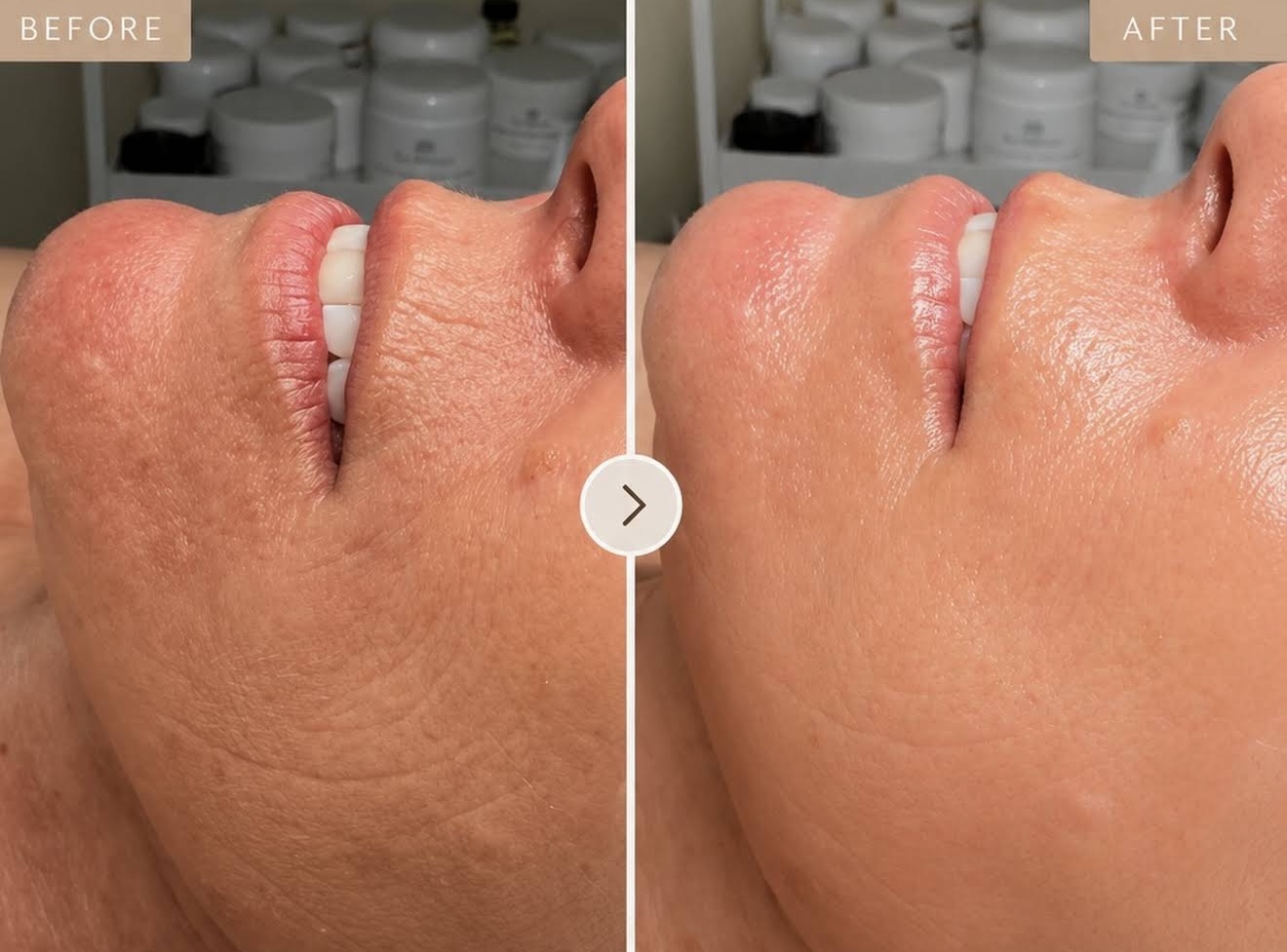 Close-up of a person's cheek before and after skincare treatment, showing smoother skin after treatment.