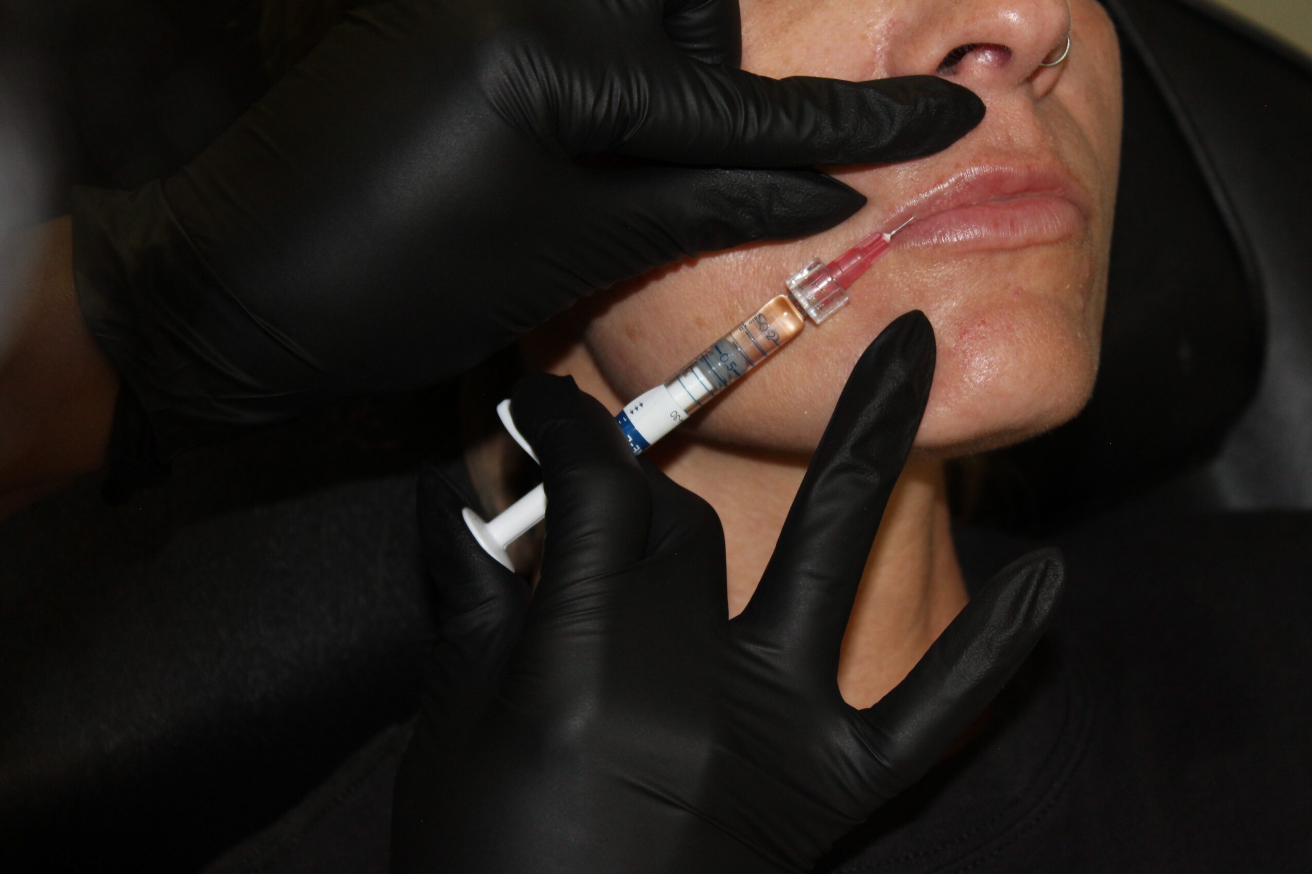 Person receiving a cosmetic injection near the lips, with gloved hands holding a syringe close to the face.
