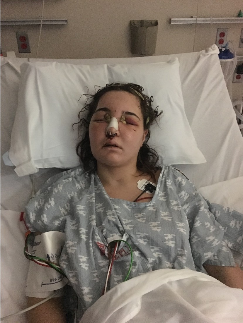 Young woman with medical tubes and bandages on face lying in hospital bed with eyes closed.