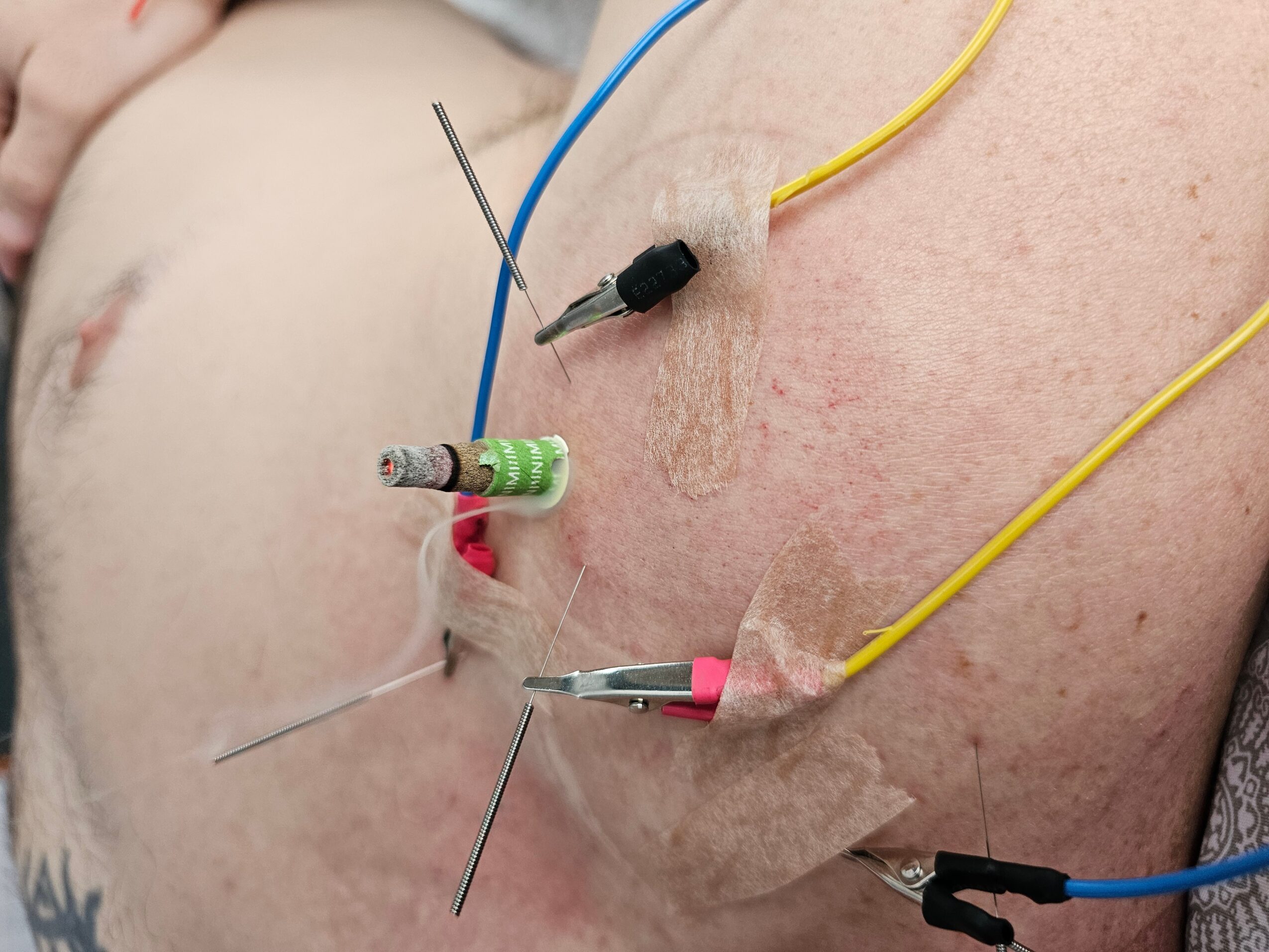 Close-up of a person's chest with medical wires and electrodes attached, taped to the skin, with visible medical equipment.
