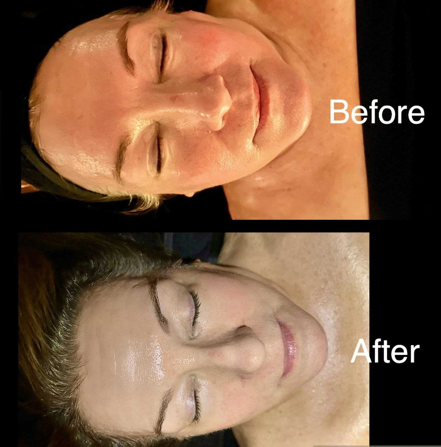 Side-by-side comparison of a woman's face before and after a skincare treatment, with her eyes closed in both images.