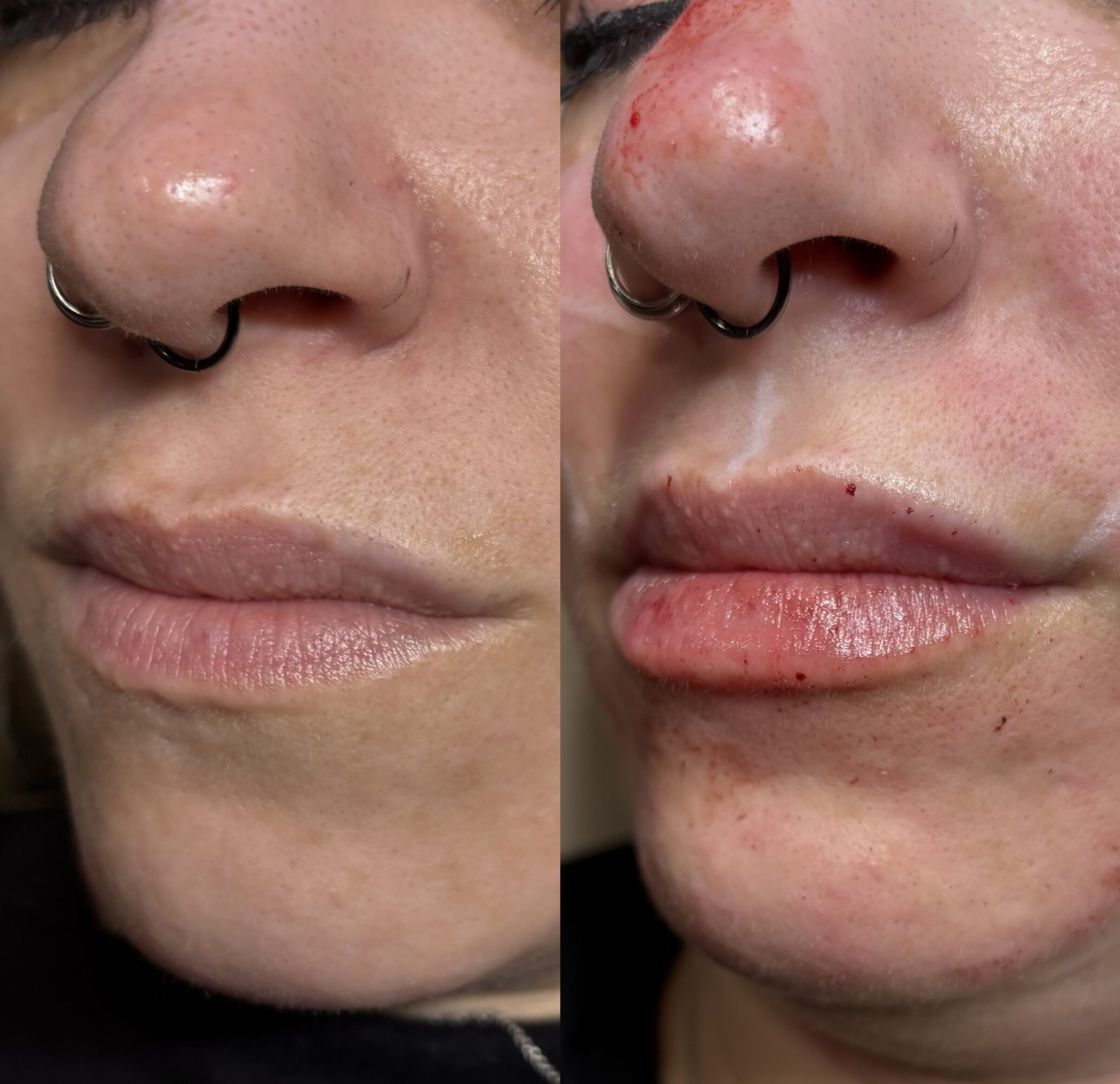 Close-up of a person's nose and lips before and after skin treatment, showing redness and irritation post-treatment.