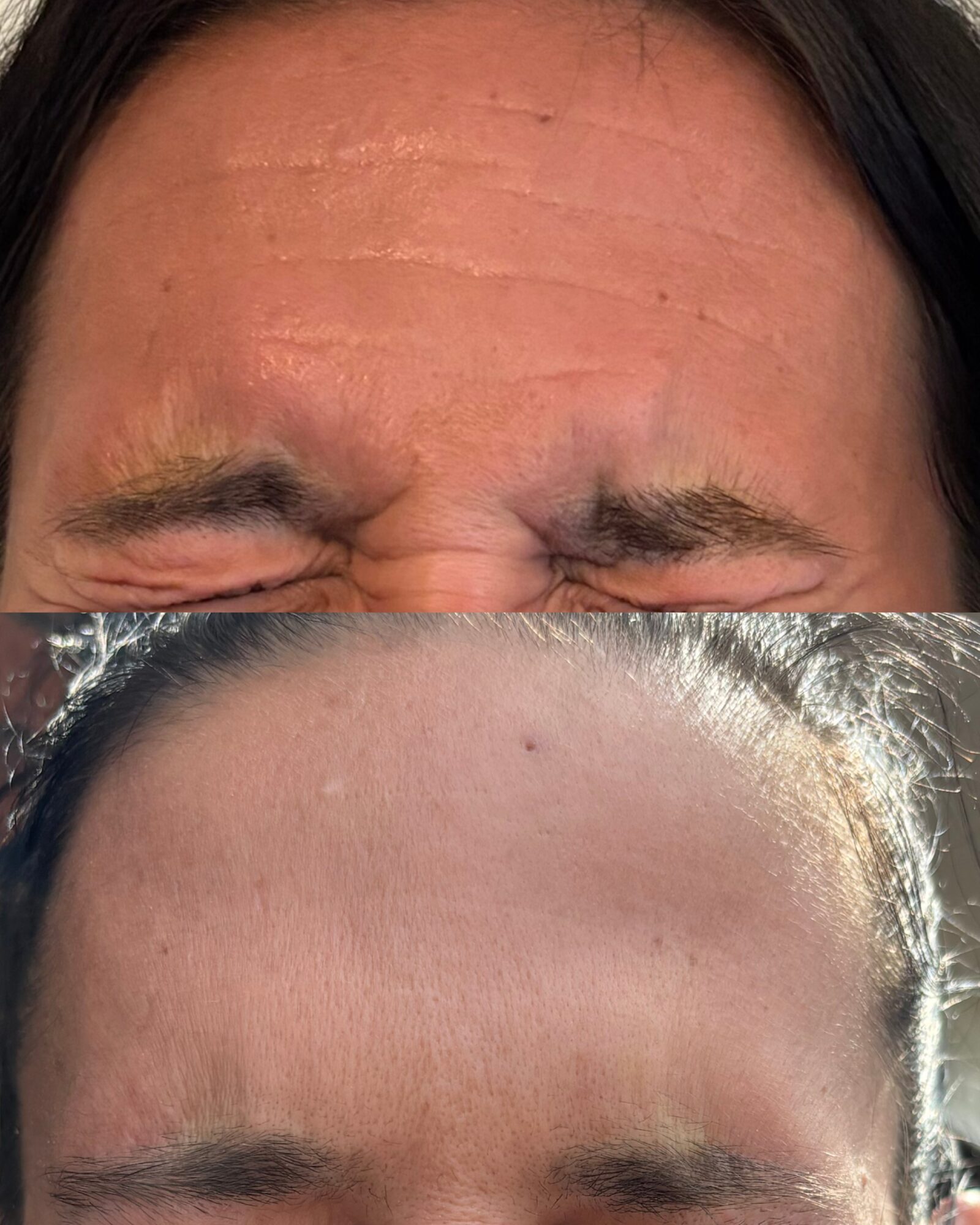 Close-up of a person's forehead with visible wrinkles and skin texture, with hair pushed back, no rotation needed.