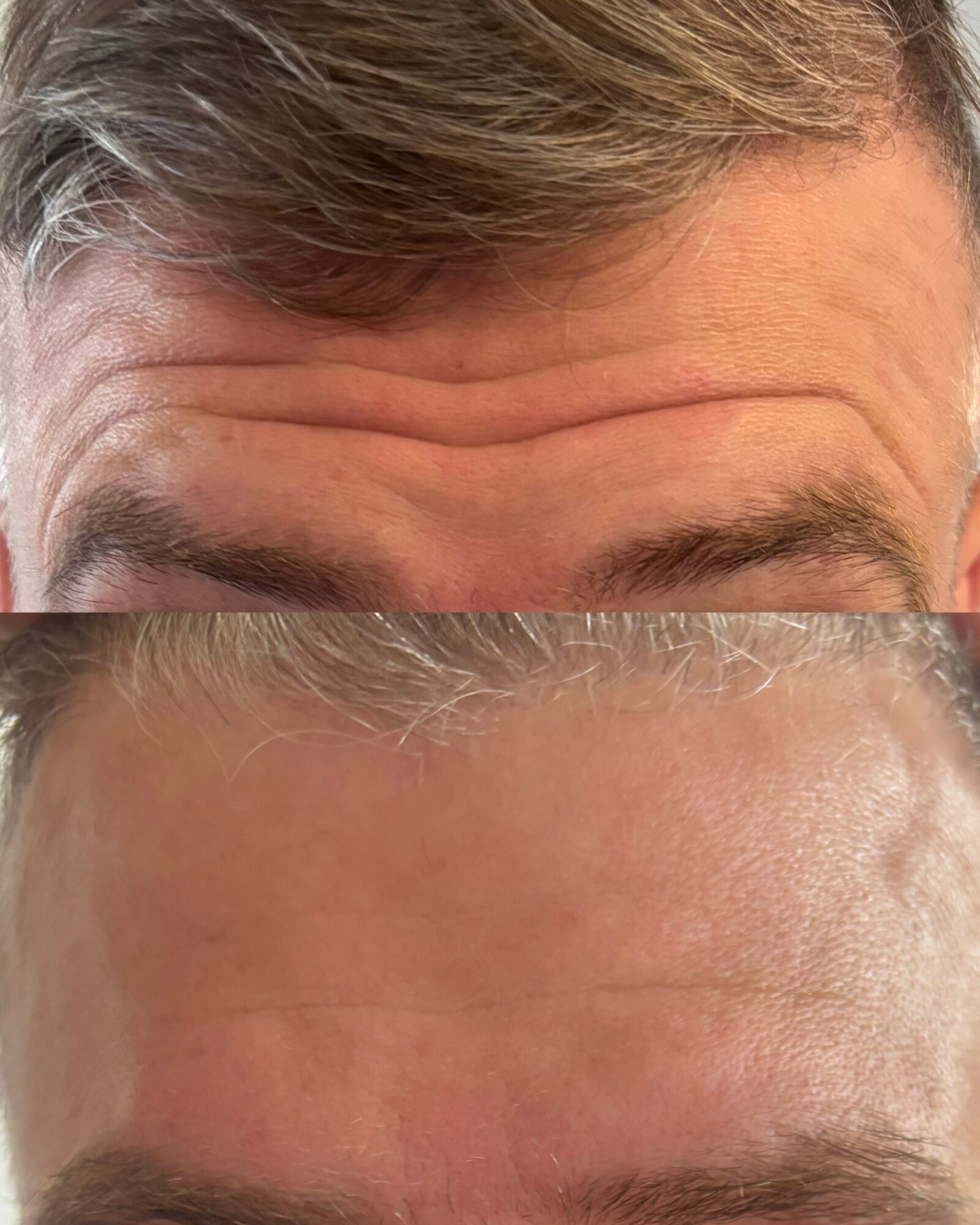 Close-up of a person's forehead with visible wrinkles and gray hair, cropped to focus on the upper face.