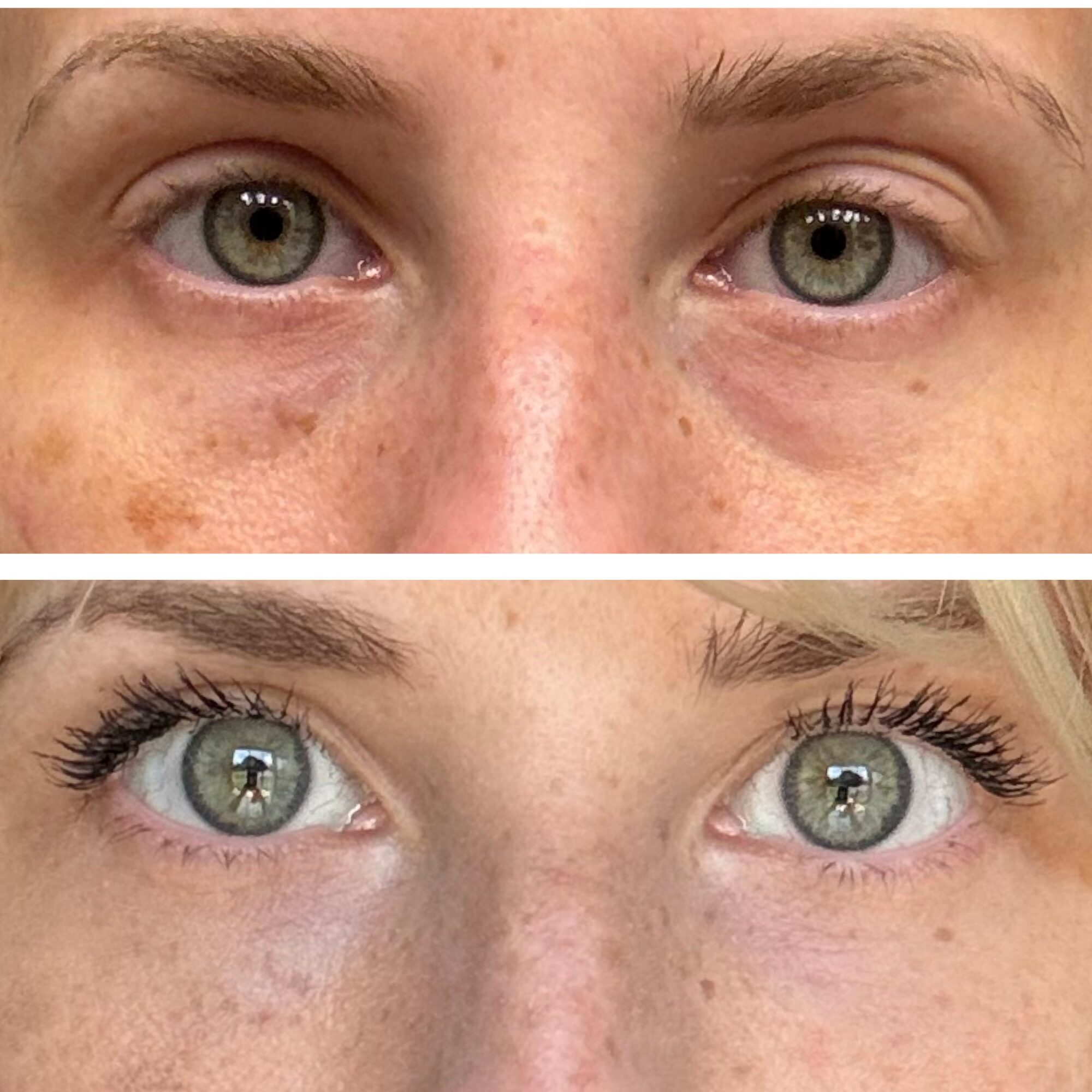 Close-up of a person's eyes before and after skincare, showing reduced dark spots and improved skin texture.