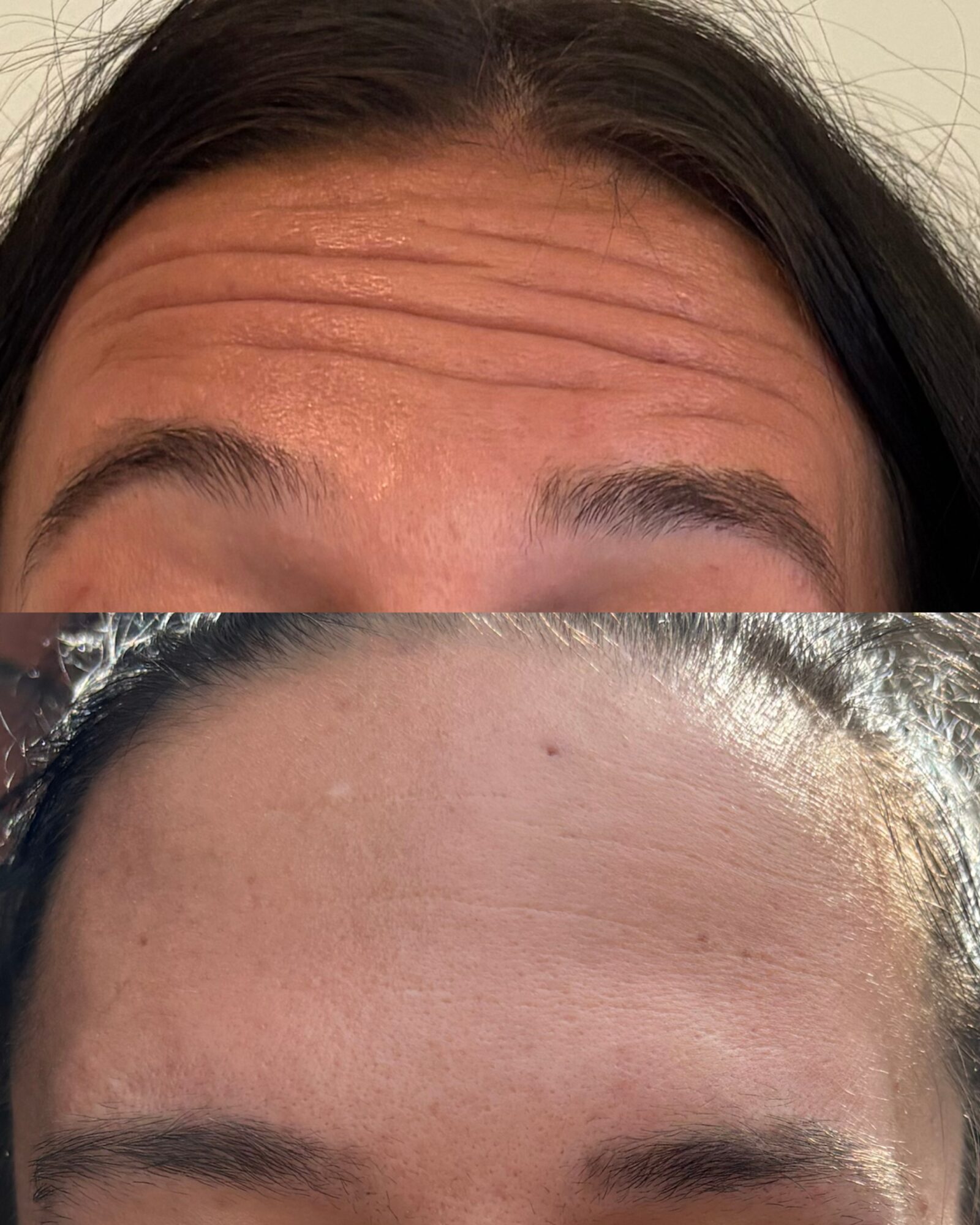 Close-up of a person's forehead with visible horizontal wrinkles and dark hair, showing the upper face area.