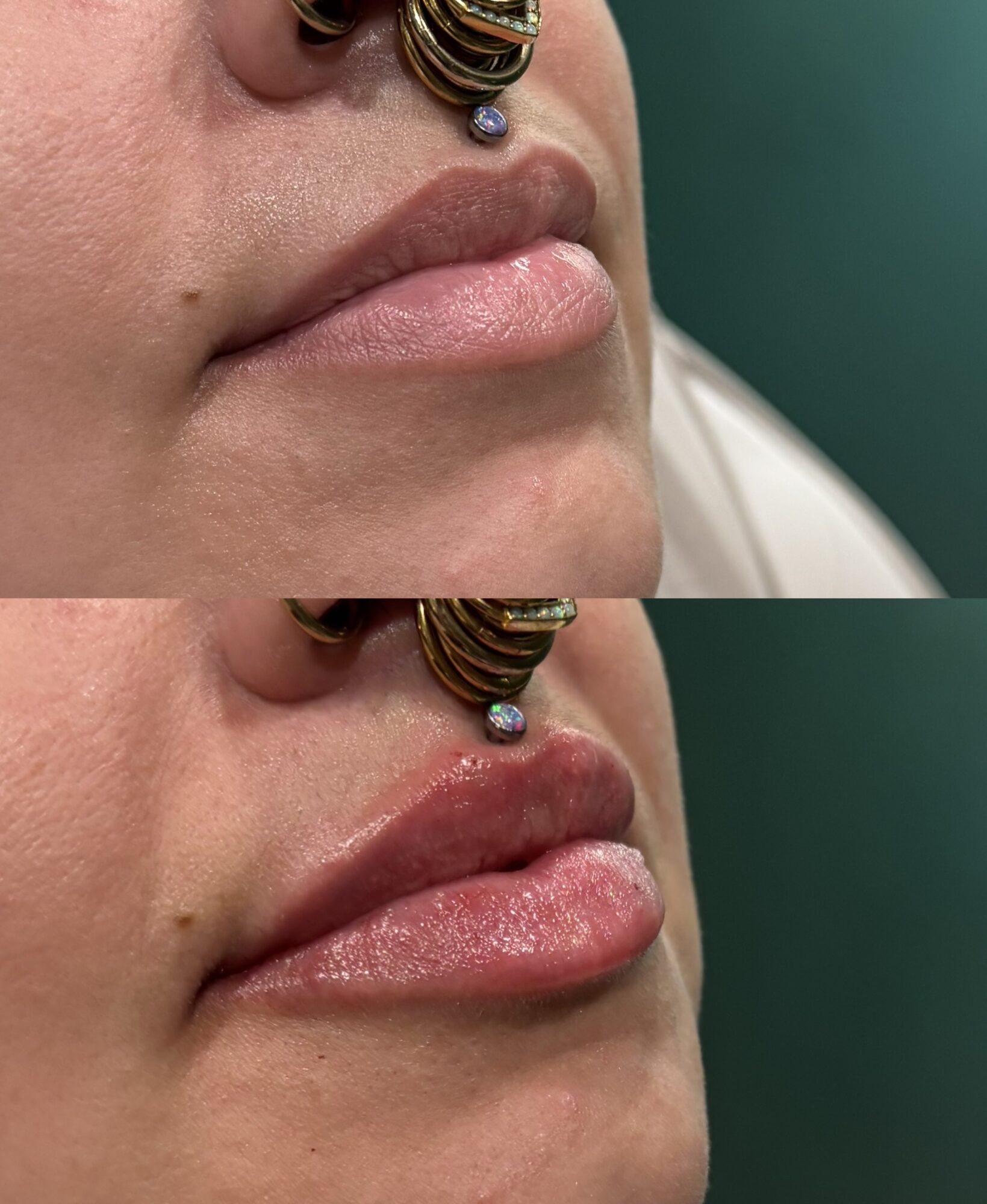Close-up of person's lips before and after lip enhancement, showing fuller lips after treatment.