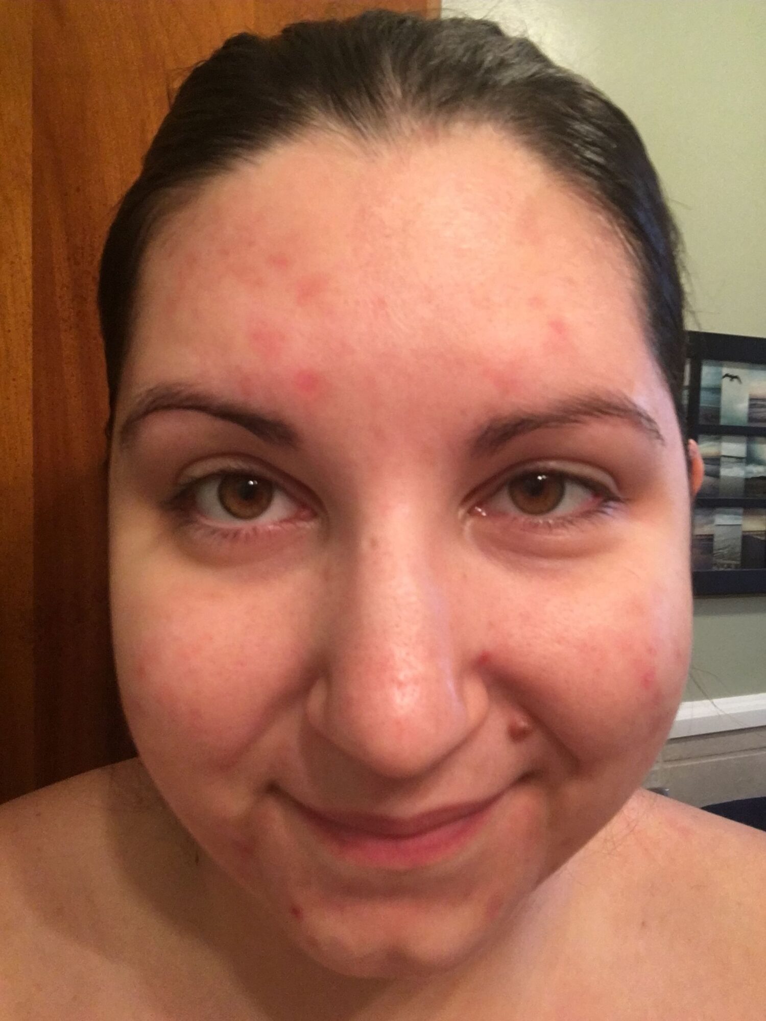 Close-up of a smiling person's face with dark hair, visible acne, and light skin, lying sideways.